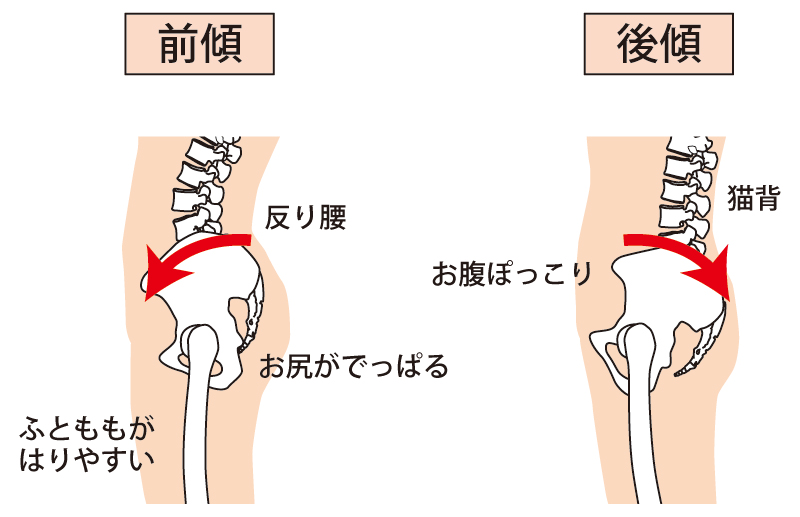 特に注意したいのは「骨盤後傾タイプ」